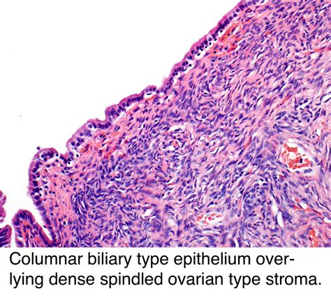 pathology outlines mucinous cystic neoplasm