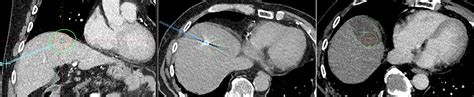 Mwa In The Liver Dome With An Inferior To Superior Oblique Trajectory