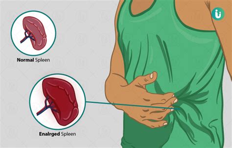 enlarged spleen symptoms causes treatment medicine