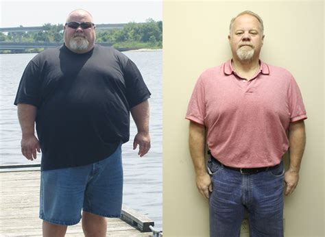 Todd S Weight Loss Before And After St Louis Bariatrics
