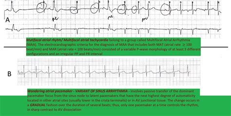 multifocal atrial rhythm  wandering atrial pacemaker mutifocal