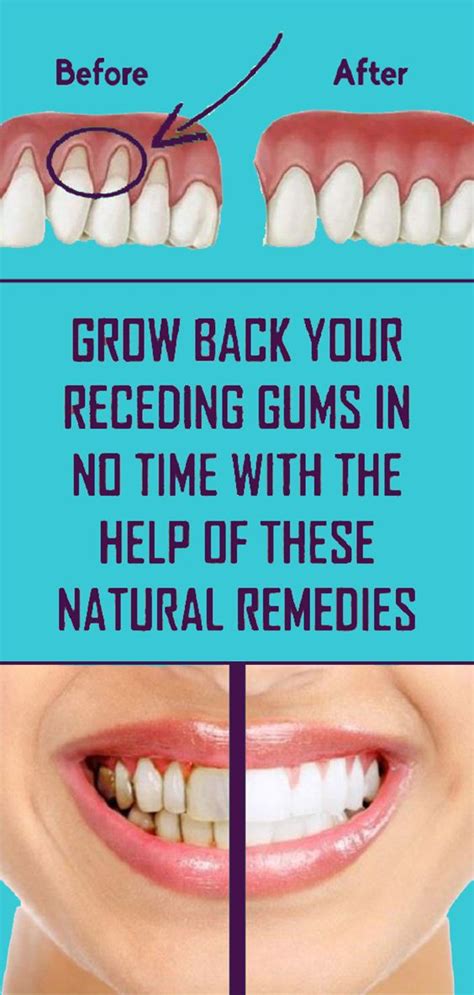 treat receding gums naturally   methods home remedies