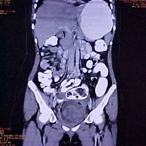 what is a pelvic ct scan healthy living