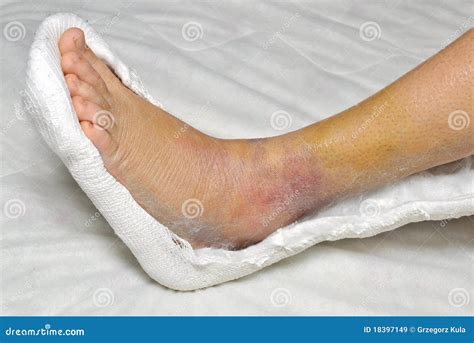 broken leg royalty  stock images image