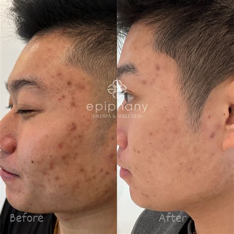 active acne acne scar treatment epiphany