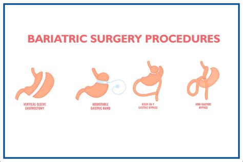 treatment  bariatric surgery  affordable cost