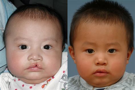 cleft lip surgery  care primary cleft lip nasal reconstruction