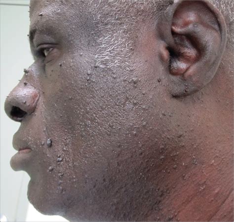birt hogg dube syndrome   african patient    mutation