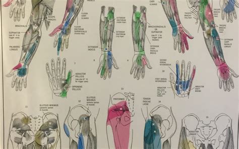 trigger points common in colac corio bay sports treatment clinic colac