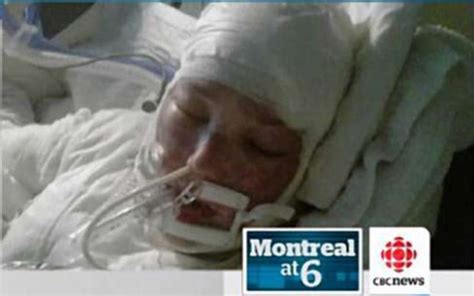 Canadian Woman Wakes From Coma After Being Burned Over 70 Of Body In