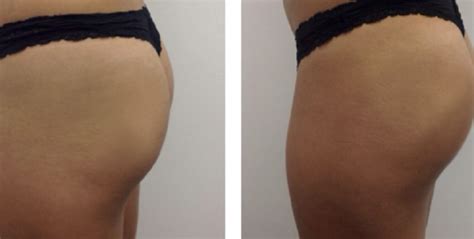 why opt for sculptra butt lift treatment body point for me