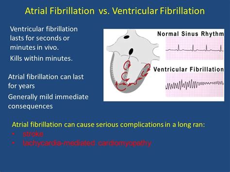 Pin On Ventricular Fibrillation