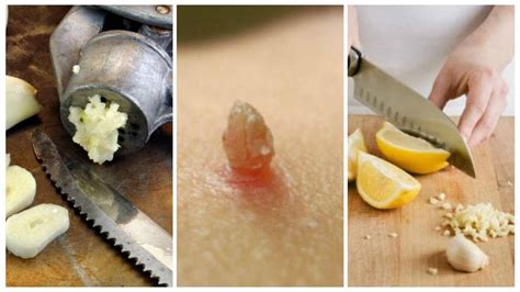 6 natural remedies to eliminate warts home remedies 2 u