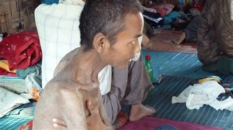 Victims Of Myanmar S Hiv Aids Struggle Cnn