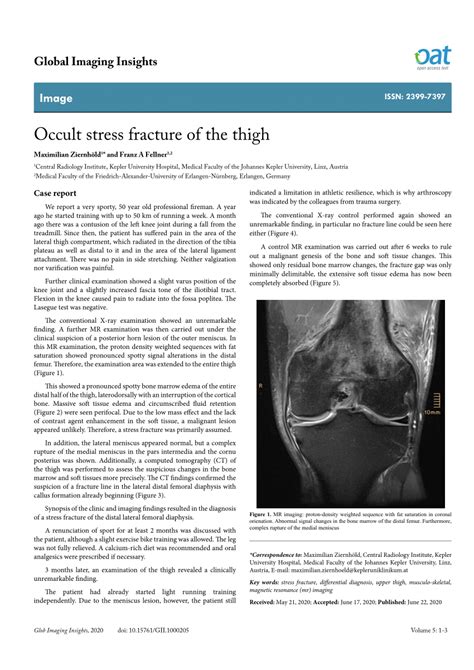 occult stress fracture   thigh