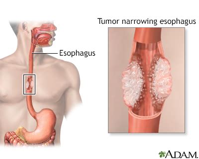 esophagectomy open information mount sinai  york