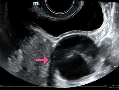 point  care ultrasound   diagnosis  ovarian  fallopian tube torsion jetem