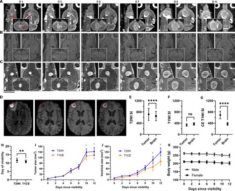 Longitudinal Follow Up Of The Brain Metastasis By 3d Quantitative Mri