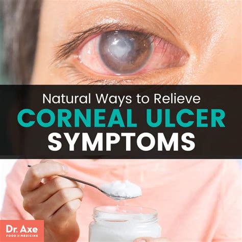 What Is A Corneal Ulcer Relieve Symptoms 11 Natural Ways Best Pure