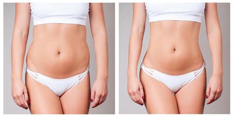 Are You A Candidate For Body Contouring Deborah D Viglione Md