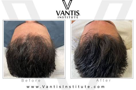 hair restoration follicle replication vantis institute
