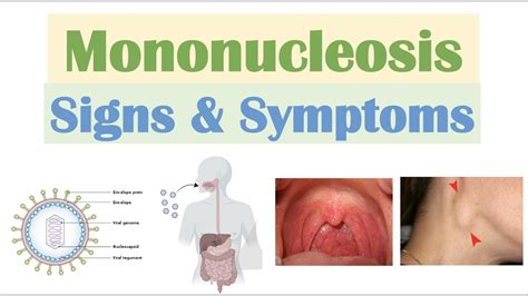 infectious mononucleosis mono signs symptoms antioxidantxcom