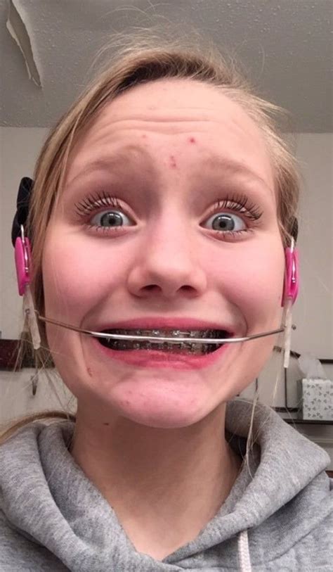 52 best orthodontic headgear images on pinterest