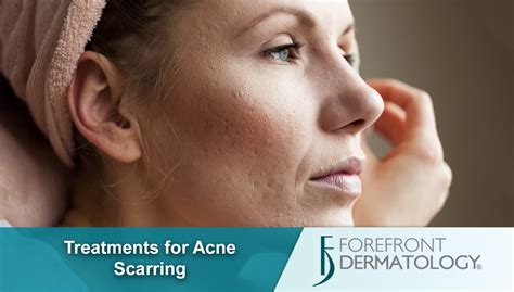 treatments for acne scarring forefront dermatology