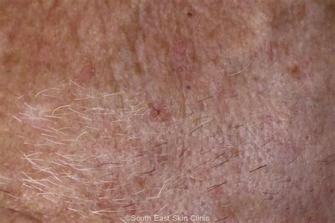 bcc basal cell carcinoma