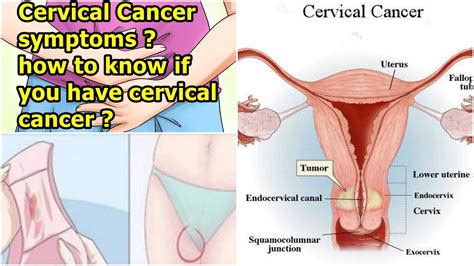 warning signs and symptoms of cervical cancer how to know if you have cervical cancer youtube
