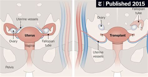 Uterus Transplants May Soon Help Some Infertile Women In The U S