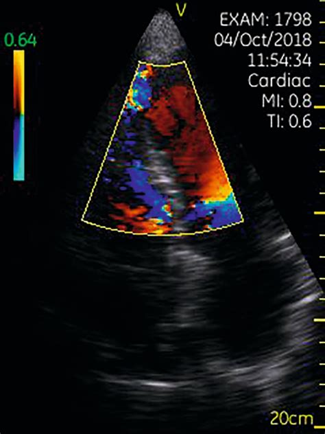 The Benefits Of Echocardiography In Primary Care British Journal Of