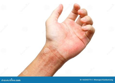 red rash  wrist stock image image  illness irritants