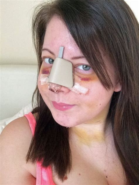 shelley skinns spends £12k on transforming her face for the perfect