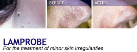 skin lesions westchase spa provide skin lesions treatment