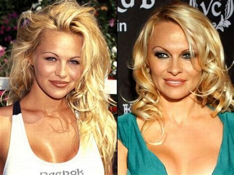 20 Worst Cases Of Celebrity Plastic Surgery Gone Wrong