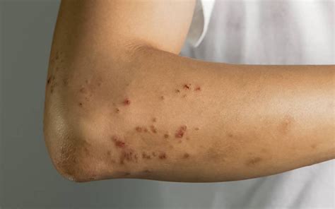 dermatite atópica é tema da semana mundial da alergia indice eu