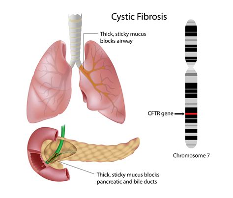what causes cystic fibrosis cystic fibrosis dna