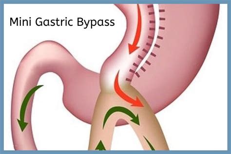 Mini Gastric Bypass Surgery In Chennai Dr Maran
