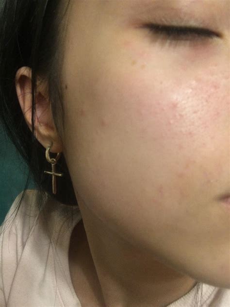 skin concerns   red bumps appeared   face