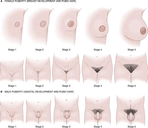 puberty breast development stages