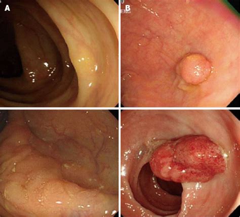 Different Endoscopic Appearances Between Right A And