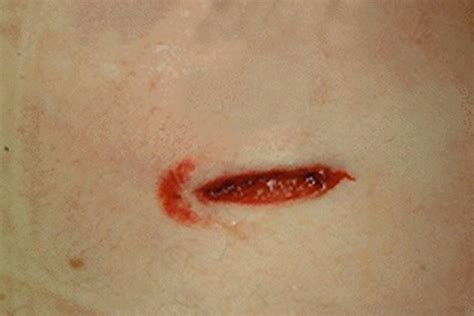 screw head puncture wound ubicaciondepersonascdmxgobmx