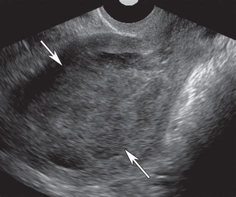 Us Of The Nongravid Cervix With Multimodality Imaging Correlation