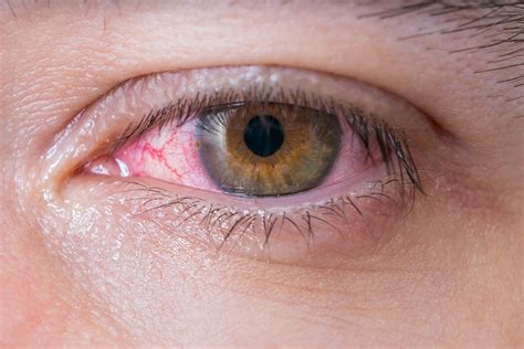 healthguidetips red eyes common symptoms   treatment