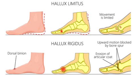 hallux rigidus hallux limitus explained   foot specialist