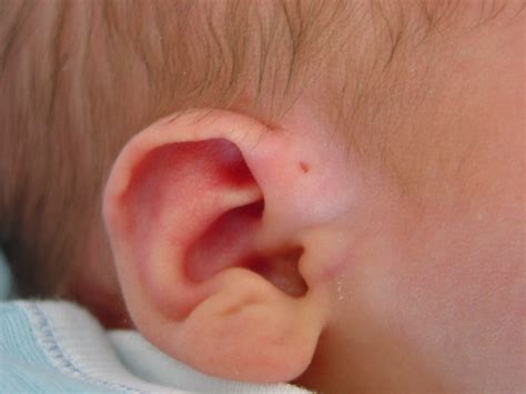 starship ear anomalies   newborn