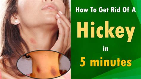 how do you get rid of a hickey how to get rid of a hickey fasthow to get rid of a hickey 6