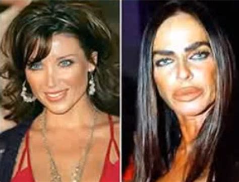 17 celebrity before and after plastic surgery disasters business insider