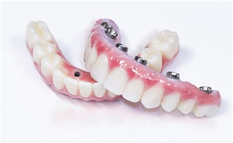 Finding References For Dental Implants Cost Zarrium